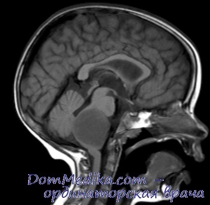 Astrocitomul cerebelului la copil cauzează, diagnostic, tratament