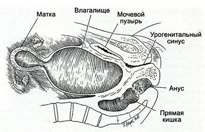 Vaginala atrezie și hymenul neperforat