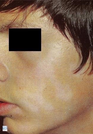 Pete albe pe pielea copiilor - vitiligo, Pitiriasis alb - Bibliotecă - Dr. Komarovsky