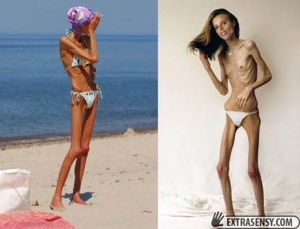 Bătălia de la psihic despre anorexie
