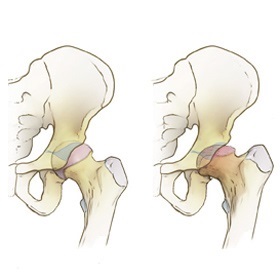 Boala Lung-Calve-Perthes a bolii comune - cauze, simptome și tratament