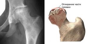 Lung Calvus Pertus și boala Calve Tratamentul și simptomele