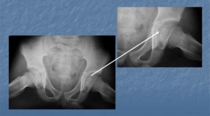 Boala Lung-Calve-perte - cauze de dezvoltare, simptome și tratament