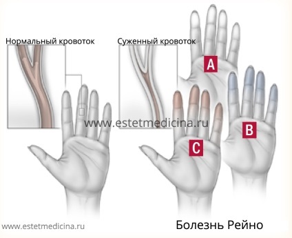 Boala Reynaud provoacă, simptome, tratament, jurnal online