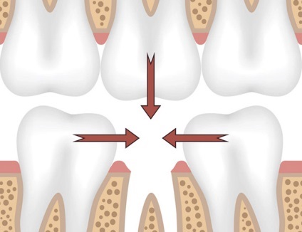 Какво заплашва липсата на зъб