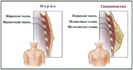 Ce este ginecomastia la bărbați - cauzele și simptomele, tratamentul, inclusiv și fără