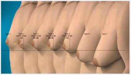 Ce este ginecomastia la bărbați - cauzele și simptomele, tratamentul, inclusiv și fără