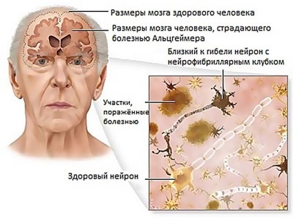 Stadiul de demență al dezvoltării, prognoza speranței de viață, vasculară