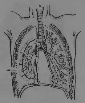 Diagnosticul și tratamentul pneumotoraxului