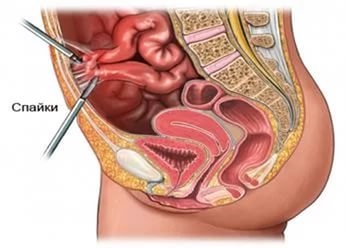 Dieta cu aderențe intestinale - recomandări eficiente