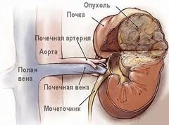 Tumori benigne de rinichi