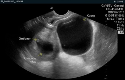 Az endometrioid petefészek ciszta és a terhesség fontos a fő