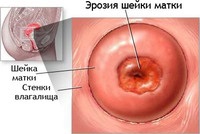 Eroziunea cervicală