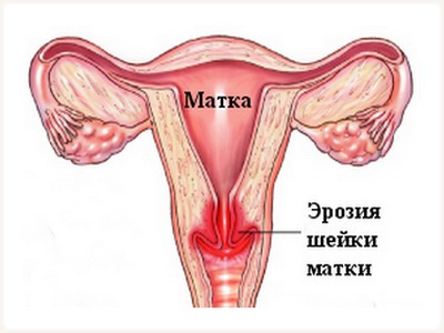 Eroziunea colului uterin, consecințele, pericolele și posibilele cauze