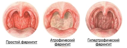 Simptome de faringită și tratament cu medicamente populare