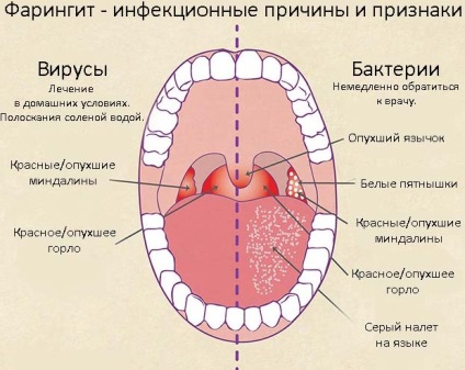 Simptome de faringită și tratament cu medicamente populare