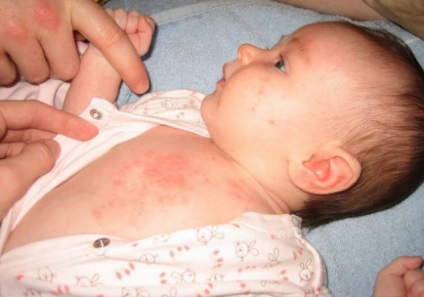 Herpes 6 tipuri la copii - tratament, virus herpes pe buze