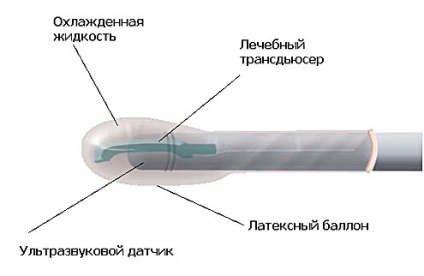 Hifu терапія раку простати