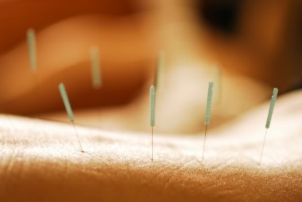 Acupunctura pentru copii la ce boli este prescrisă și cum se ajustează copilul la procedură