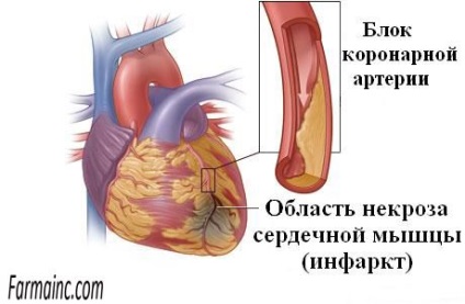 Infarctul miocardic