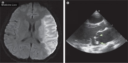 Accident vascular cerebral, endocardita infecțioasă și chistul valvei mitrale