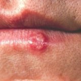 Cum să scapi rapid de herpes pe buze cu mijloace improvizate - medicul tău aibolit