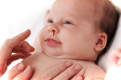 Hogyan lehet megállítani a baba vérét, elsősegélyt