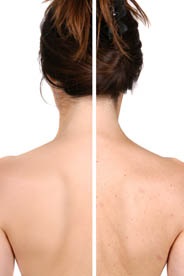 Cum să eliminați petele de acnee pe spate