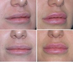 Cum de a mări buzele fără intervenție chirurgicală - clinica olga ignatyevoy g