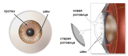 Keratoprosthetics a corneei ochiului - preturi accesibile pentru chirurgie la Moscova! Medicii experimentați,