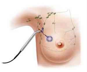 Chistul mamar - mamografie - catalog de articole - sănătatea femeilor și ginecologie