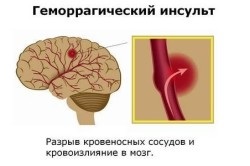 Кома при інсульті головного мозку