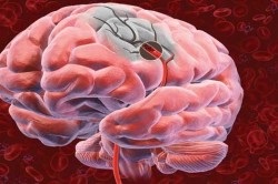 Coma în accident vascular cerebral al creierului