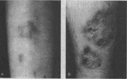 Afecțiuni cutanate ale bolilor endocrine