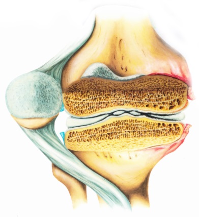 Tratamentul artritei articulației genunchiului