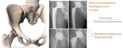 Tratamentul endoprotezelor articulare la șold în străinătate, prețurile la clinici, revizuirile pacienților -