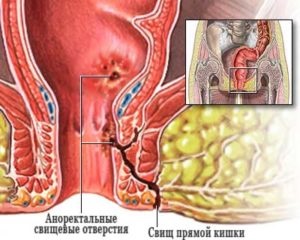 Tratamentul hemoroizilor purulente - ce medicamente și unguente să utilizeze pentru hemoroizii purulente