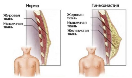 Tratamentul ginecomastiei adevărate la băieți adolescenți la vârsta de 12-15 ani și 17 ani