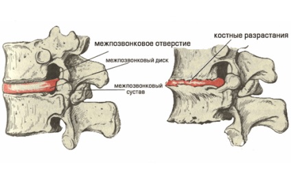 Tratamentul herniei intervertebrale la domiciliu