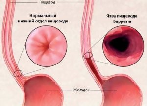 Tratamentul ulcerelor esofagului prin remedii folclorice la domiciliu