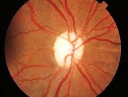 Tratamentul bolilor retinei și ale nervului optic, oftalmologia familiei medicului nina alexandrovna