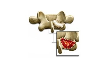 Metastazele cancerului în simptomele coloanei vertebrale, tratamentul, clasificarea, cauzele, complicațiile, prevenirea,