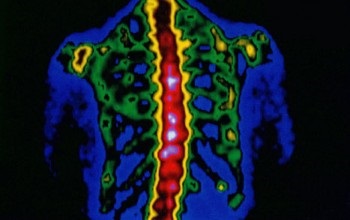 Metastazele cancerului în simptomele coloanei vertebrale, tratamentul, clasificarea, cauzele, complicațiile, prevenirea,