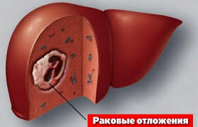 Metastaze în simptomele hepatice, prognostic și tratament