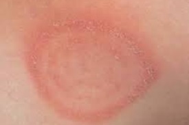 Bőr mycosis - ez a fertőző betegség veszélye
