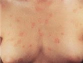 Bőr mycosis - ez a fertőző betegség veszélye