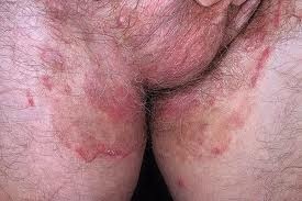 Mycosis de piele - pericolul acestei boli infecțioase