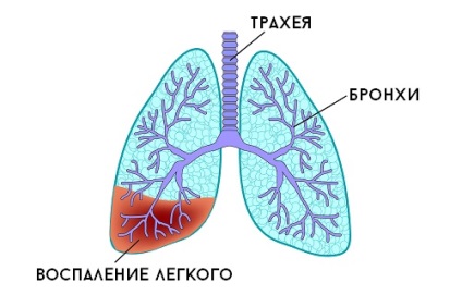 Vannak-e köhögés a bárányhimlővel és hogyan kell kezelni?