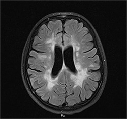 Mert cu hipertensiune arterială (hipertensiune arterială)