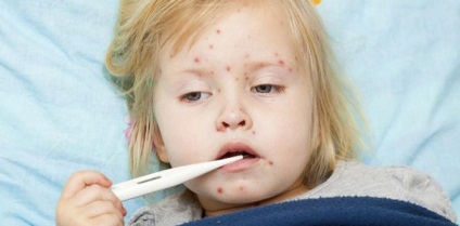 Coryza și tuse cu tratamentul și prevenirea varicela